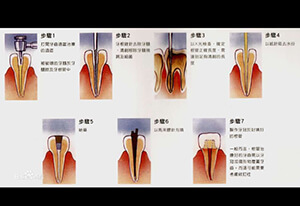 看着都疼的牙齿根管治疗全过程