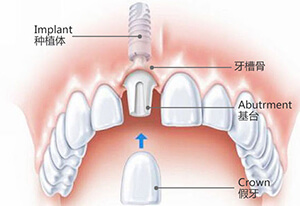 两分钟看懂种牙全过程，一定要保护好我们的牙齿