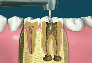 树脂补牙过程，牙齿龋坏后的修复过程！