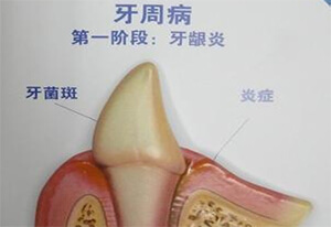 牙周炎